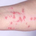 Pride PANIC – Mpox OUTBREAK in Boston… Boston residents encouraged to get mpox vaccine amid uptick in cases