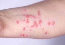 Boston residents encouraged to get mpox vaccine amid uptick in cases